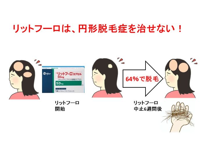 円形脱毛症　病院